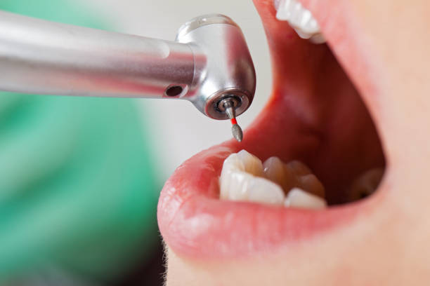Best Emergency Tooth Extraction in Taylorvle, IL